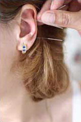 ear acupuncture